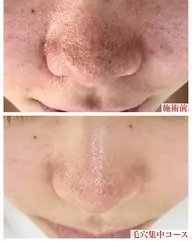 大人気毛穴エクストラクション！どんな毛穴もお任せください😊！黒ずみ毛穴、たるみ毛穴、メイクノリが悪いなど。