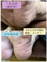 【モニター特別クーポン】◆足裏トラブル(中〜重度)◆タコ/魚の目/角質【トラブルケア】