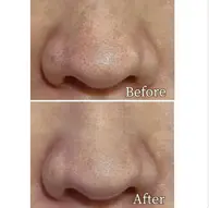 ⭐︎黒ずみ毛穴撃退⭐︎ 肌質改善　毛穴洗浄✨