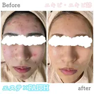 《メニューに迷われてる方》お肌を見させて頂いてから最適なコースをご案内致します😽🫧