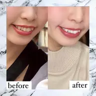 💓セルフホワイトニング💓初回体験10分×3回✨口元のメイク映え🙆🏻♀️メンズにも大人気🙆♂️