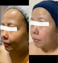 強い肌にする為に❣️2Bバイオトリートメント 1g オプションのリンパケア無料➕アフターエステ50分付💆♀️