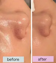 ✨毛穴キュ！光フェイシャルで美肌✨¥8,900→¥3500