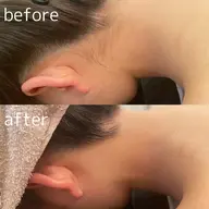 脱毛デビューさんにオススメ💗最新脱毛機SHRワンコイン脱毛実施中💗今ならお好きな箇所を３箇所選550円で脱毛できます