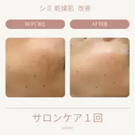 透明感が欲しい方におすすめ!“細胞活性機械“セルサー美白コース*女性限定*マッサージつき