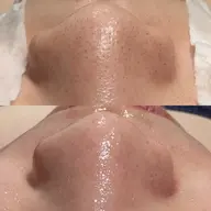 👶🏻毛穴洗浄+小顔コース👶🏻毛穴ツルツル、黒ずみ除去、スッキリ小顔引き締め✨