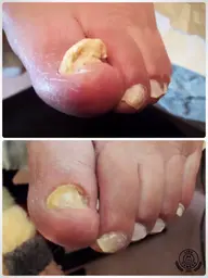 【モニター】肥厚爪ケア（10本ケア込み）