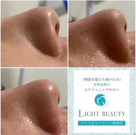 韓国式毛穴洗浄・光フェイシャル（全顔）