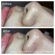 花粉での肌荒れにも🙆‍♀️【シミシワ・ニキビ・毛穴・美白】肌育ハーブピーリングベーシックコース60分🌿