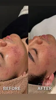 【肌質底上げ🌿】ハーブピーリング