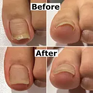【男性可】セミナー無料モデル募集❣️巻き爪、変形・肥厚爪、うおの目、タコでお悩みの方🦶詳細は詳細情報をご覧ください😊