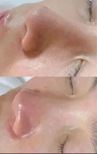 【人気NO.3】韓国小顔コルギ+美容液導入+毛穴洗浄（全顔角栓除去）80分（オイルデコルテ付き，パック2枚）