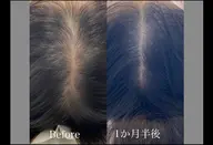エステで発毛ができる✨効果が早い100％幹細胞培養上清液　ノアグロウスカルプ　メンズ可