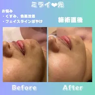 🩵もっちりちゅるん肌🩵時短で頬、口角キュッと小顔フェイスラインくっきり🫧ミライの光と特殊ジェル🍊で効果持続✨️
