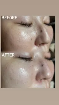 🫧毛穴洗浄🫧レディースのみ‼️