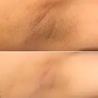 レディス【ワキ・脱毛】当日予約不可❌脱毛しながら、美肌効果も抜群💖