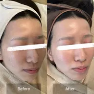 🌿剥けないハーブピーリング✨【剥離なし】【毛穴洗浄】【美容液】ニキビ/ニキビ跡/黒ずみ/水光肌/剥離ありは+1000円