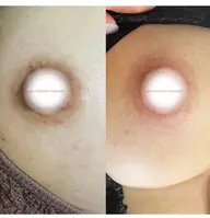 🩷ローマピンク🩷　ニップル　半額キャンペーン　無料カウンセリング予約！アフタークリーム込み132000円