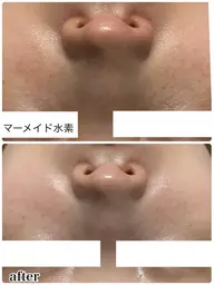 【ハリ・キメ・ツヤ・水光肌✨】マーメイド水素トリートメント🧜‍♀️🫧