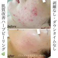 【本格ニキビケア】肌質改善ハーブピーリング50分