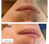 【ご新規様限定】お顔の産毛！一部位お試し！糸脱毛¥1500