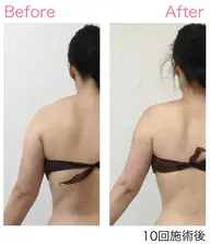 ★モニター募集 上半身痩せ 60分 10回【二の腕・背中・腰】