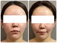 通常価格【ほうれい線・ゴルゴライン・マリオネット】改善凝り固まったエラ頬を撃退☆80min【¥16500→¥8800】