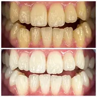 【初回体験】事前準備不要の手ぶらok👌スーパーホワイトコース「歯のセルフホワイトニング］直前予約大歓迎✨