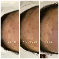 【20代​〜​30代メンズ限定👱‍♂️】フェイシャルエステ＋毛穴吸引（ニキビ、毛穴、皮脂）