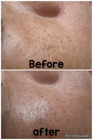 毛穴洗浄、ハンドエステ、パック