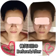 2週間以内骨気再来/石膏パック無し