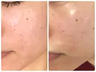 【贅沢美容液パック】超音波エステ+肌悩み別パック❤️