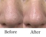 【ご新規様*角質/くすみ/毛穴/肌ケア】頭蓋骨小顔矯正+選べる肌ケア 通常16,000円→ミニモ限定初回10,700円