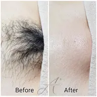 VIO シュガーリング🍋脱毛【2回目以降のお客様】