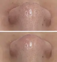 【毛穴洗浄シルバー】超音波スチームで毛穴をしっかり開いて丁寧に毛穴の汚れを取り除きます！