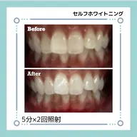 セルフホワイトニング【５分×3回照射】