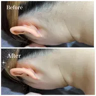 🔥お試しパック🔥全身脱毛3回(お顔+VIO込み)