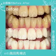 💙美容💙セルフホワイトニング30分+カウンセリング