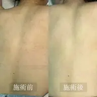 【4月限定✨】部分脱毛　無料