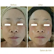 ✨新登場✨50分🕑️💎話題のニードルピーリング💎チクチク感がクセになる方続出💕💕