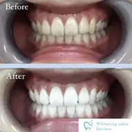 【初回限定】8分×2回照射💡セルフホワイトニング6,600円→2,970円🫧効果実感高いパープルライト使用‼️