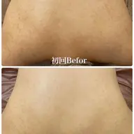 【背中上】REVIハーブピーリング⭐️背中のニキビが気になる方へ✨陶肌パウダー1gプレゼント+生酵素付💓