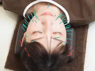 【最強リフトアップ🏅】サボテン美顔鍼➕ヘッドマッサージ🌵計70分