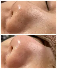 お鼻毛穴エクストラクション