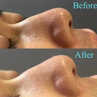 ☘️4月限定☘️毛穴洗浄コース