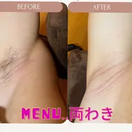 女性🔴わきワックス脱毛『匠道』🩷⟬トーンアップでツルツル👙⟭