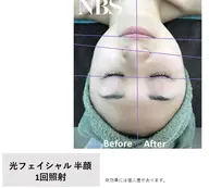 初回限定/肌管理に最適★光フェイシャル！デコルテマッサージ・イオン導入込¥6,600→¥5,940【メンズ&レディース】