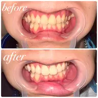 【8回券🎫】驚きのトーンアップ！全16回照射(1セット10分✖️2照射8回分)🦷ハイパワーセルフホワイトニング✨