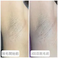 脇脱毛1回