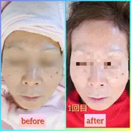 小顔DX  フォーカスネオ×小顔ケア✨